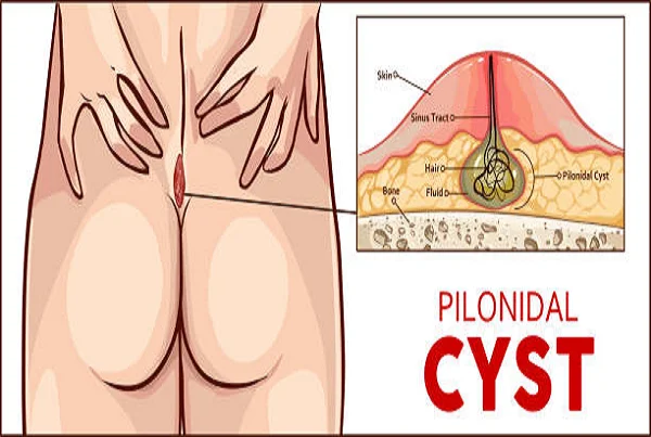 Pilonidal Sinus