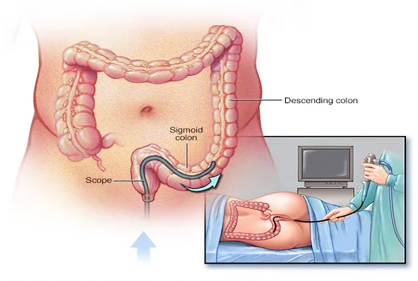 Sigmoidoscopy