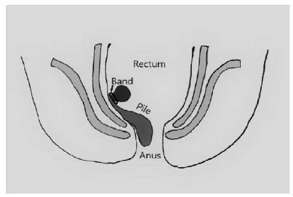 Rubber Band ligation