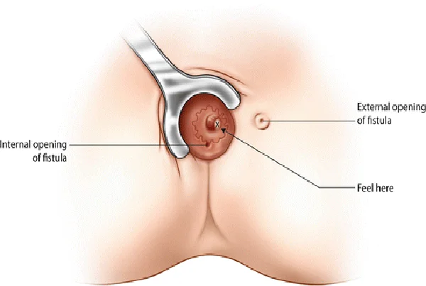 Chemical Fistulotomy