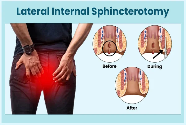 Lateral Subcutaneous Internal Sphincterotomy