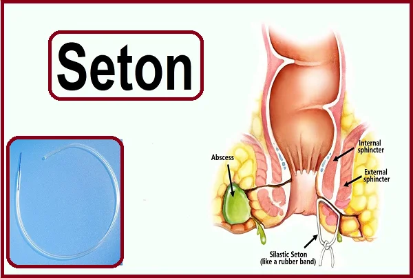 Seton Method