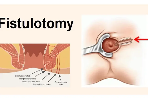 Fistulotomy