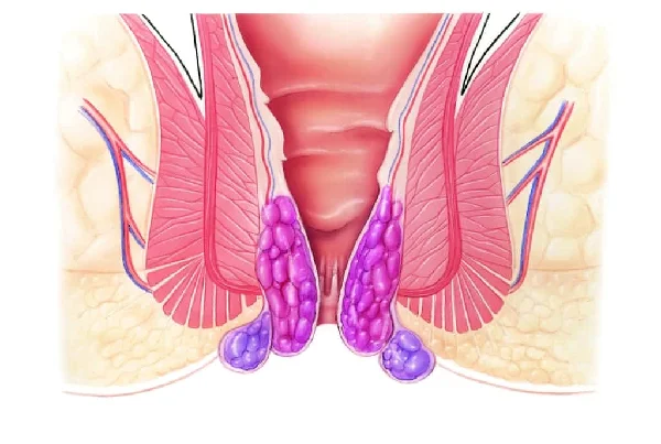 Minimum invasive Procedure for Haemorrhoids