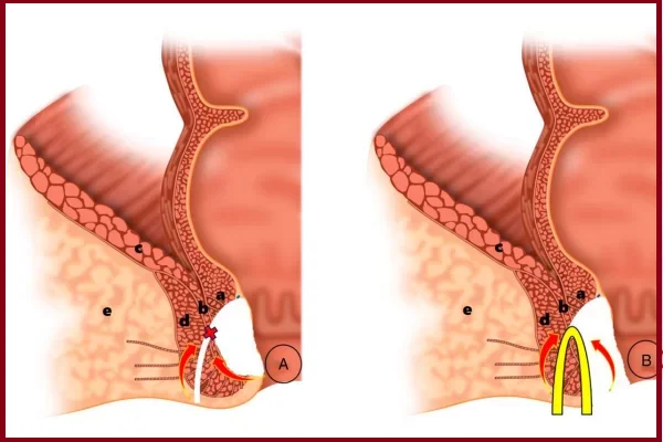 LIFT Technique for Fistula